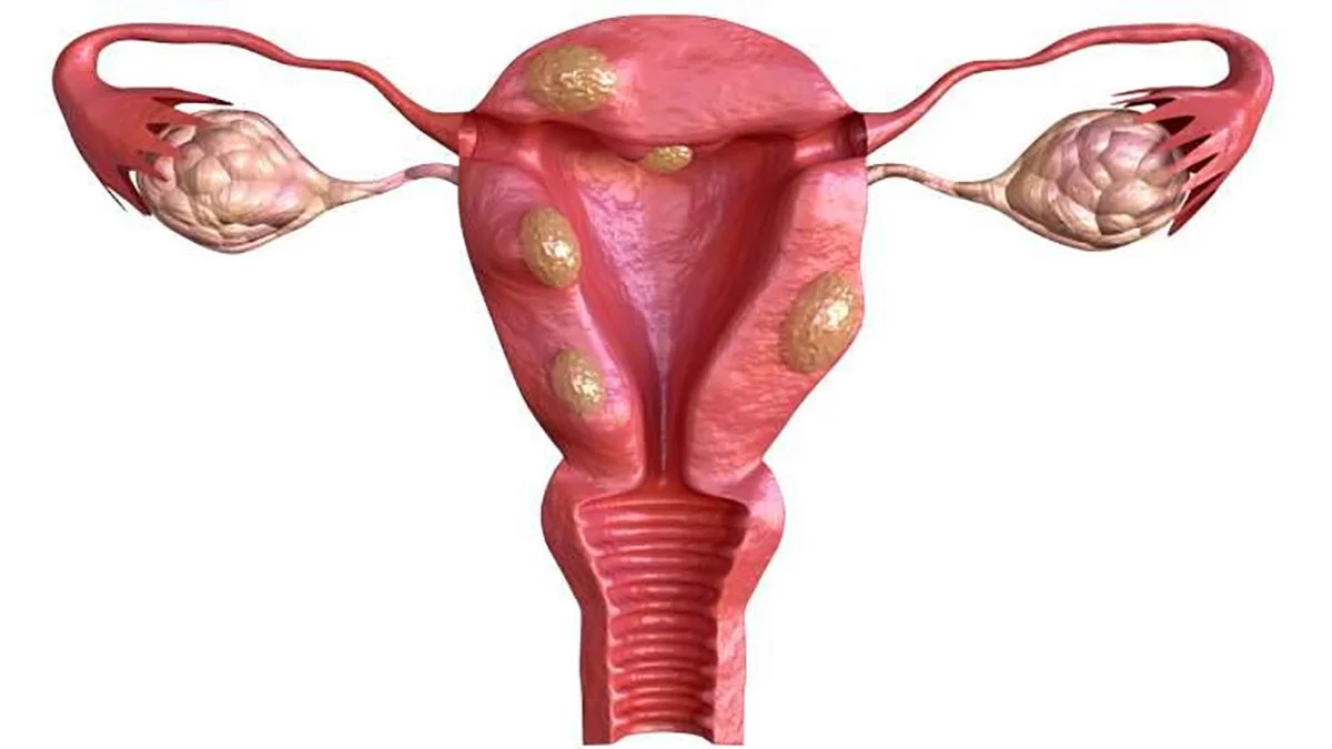mioma_uterino.jpg