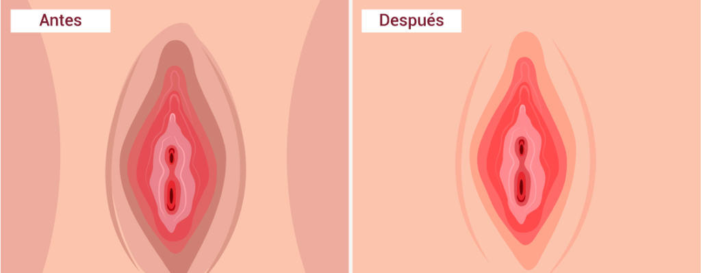 Blanqueamiento-Genital