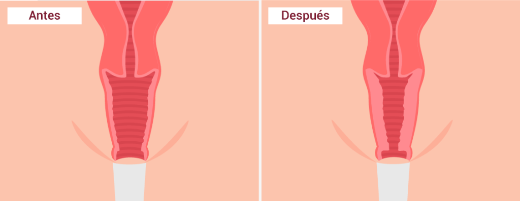 Vaginoplastia